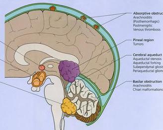 脑水肿