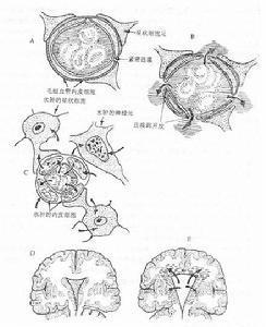 脑水肿