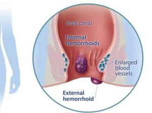 痔疮
