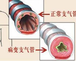 慢性支气管炎