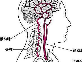 脑动脉硬化