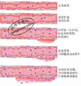 急性炎症时血流动力学变化模式图