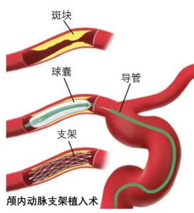 支架