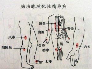 脑动脉硬化