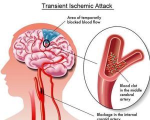 短暂性脑缺血发作