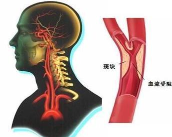 脑动脉硬化