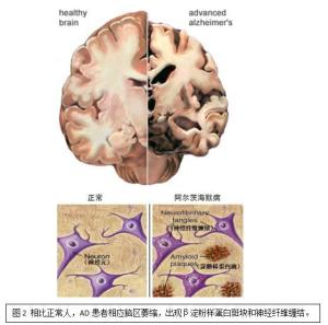 阿尔兹海默症 aβ示意图