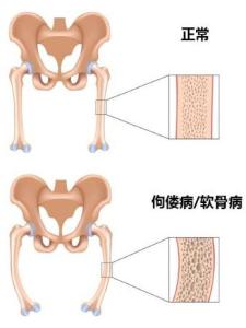 佝偻病