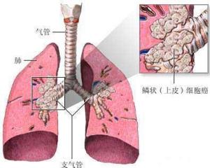 肺癌